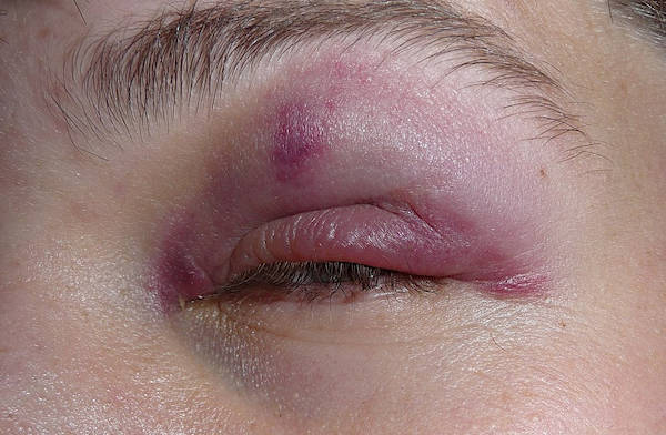 bruised - black eye